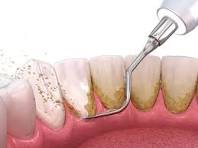 Teeth Cleaning